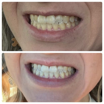 Bianca Bright whitening pen before and after results showing visible whitening